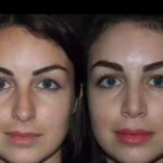 Septoplasty in Dubai