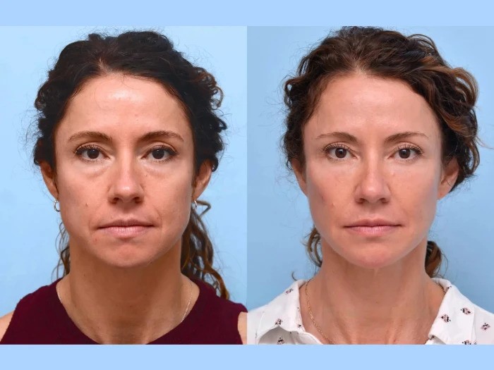 Best Plastic Surgeons in Dubai for Thread Lift Long Lasting Results