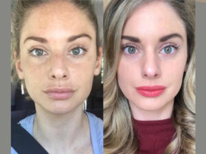 Radiofrequency (RF) Microneedling Injections in Dubai