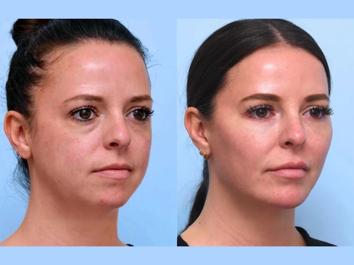 Best Doctors in Dubai Integrate Thread Lift Techniques for Non-Surgical Anti-Aging Solutions