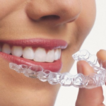 Invisalign-Aligners