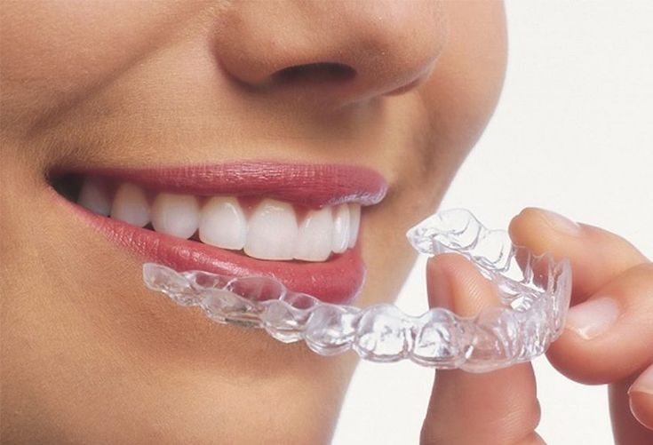 Invisalign-Aligners
