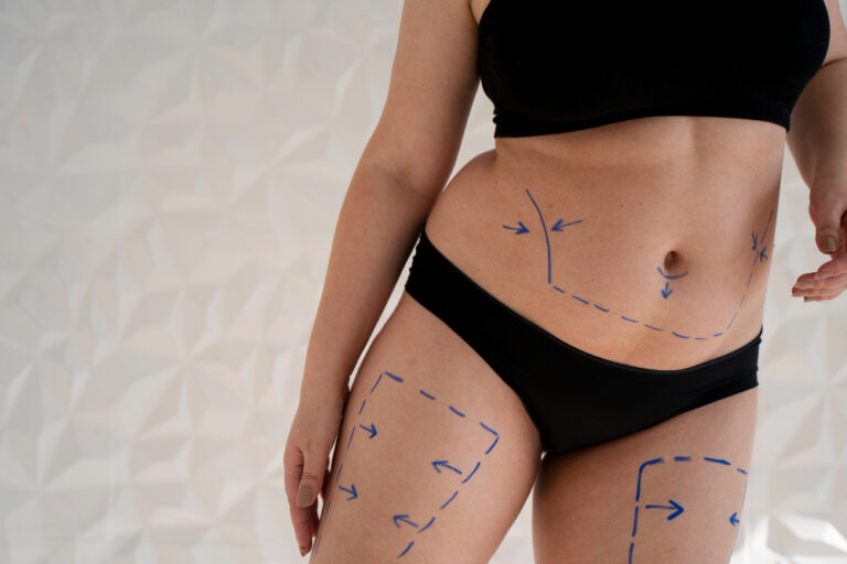 Liposuction in Dubai