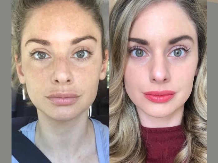 Radiofrequency (RF) Microneedling in Dubai