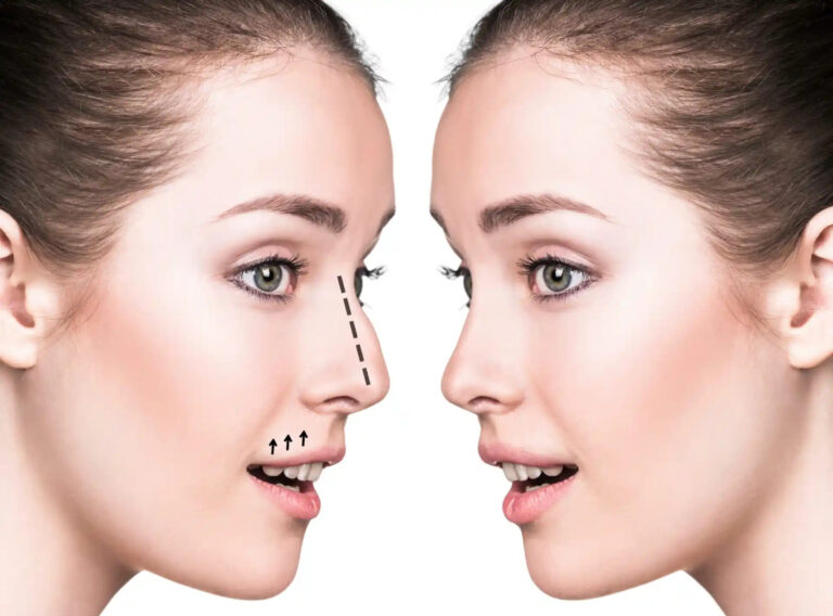 Rhinoplasty in Dubai
