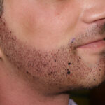 beard hair transplant in islamabad