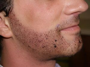 beard hair transplant in islamabad