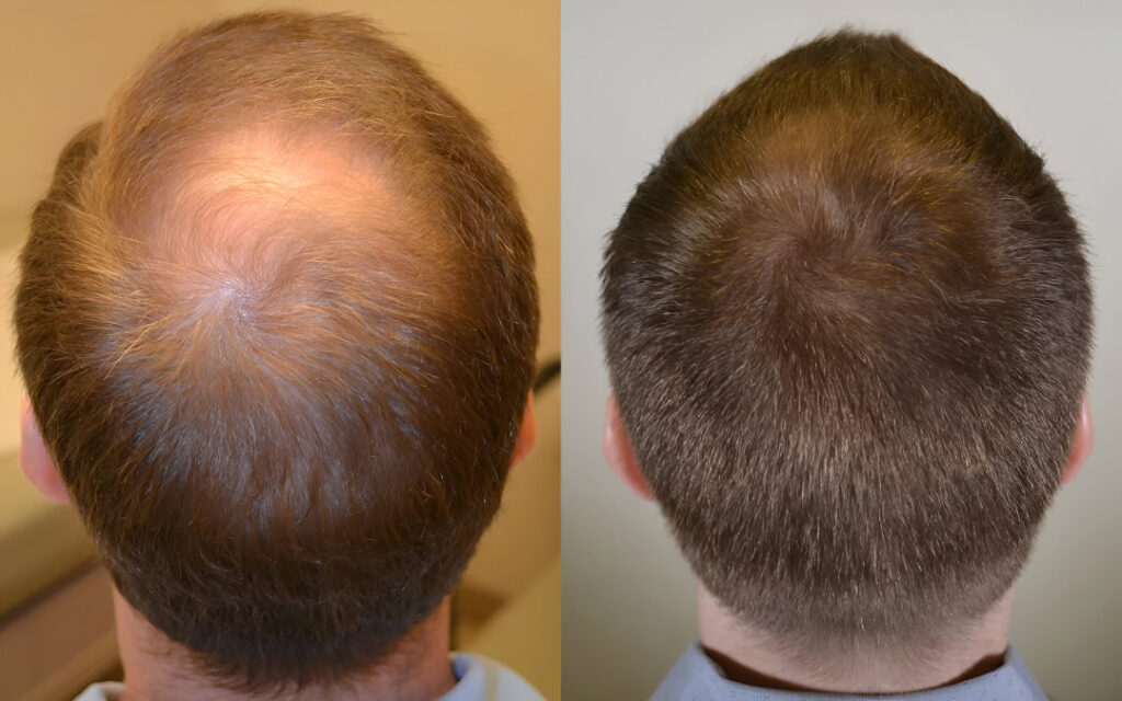 exosomes for hair loss