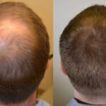 exosomes for hair loss