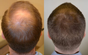exosomes for hair loss
