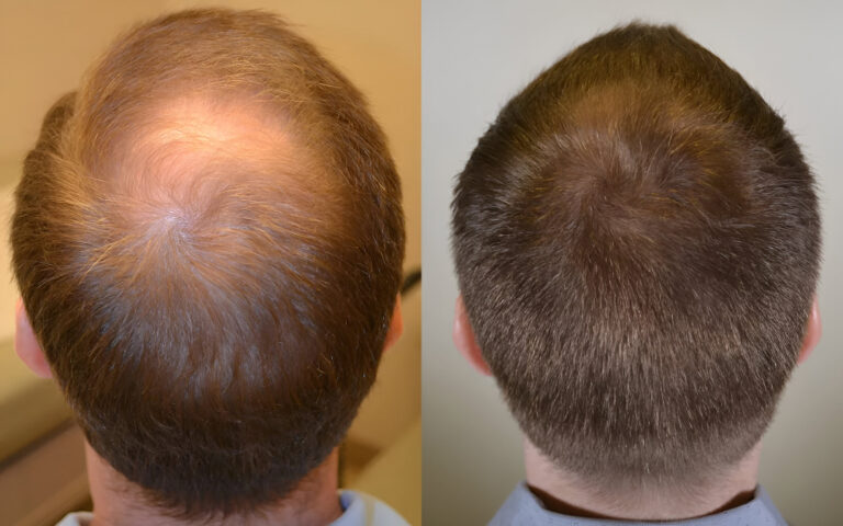 exosomes for hair loss