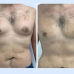 gynecomastia in dubai.jpg (1)