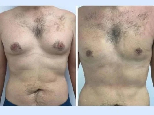 gynecomastia in dubai.jpg (1)