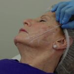 thread lift in islamabad