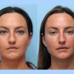 Best Aesthetic Clinic in Dubai for Modern Thread Lift Solutions Lifting Sagging Skin Naturally