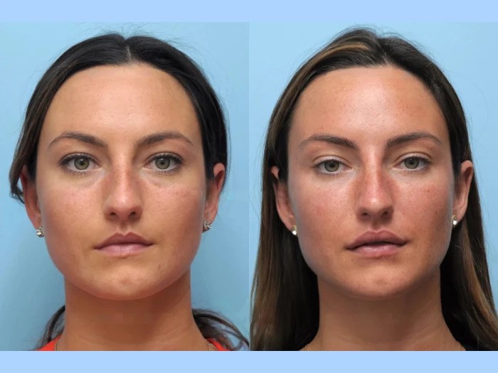 Best Plastic Surgeon in Dubai Thread Lift Improving Firmness Contour and Symmetry