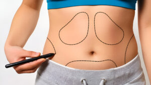 Liposuction Treatment