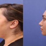 chin lipo treatment in