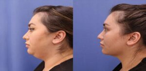 chin lipo treatment in