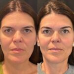 Thread lift in Dubai Improving Facial Symmetry and Tone