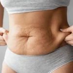 tummy tuck surgery