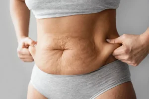 tummy tuck surgery