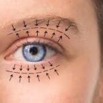 Blepharoplasty in Dubai