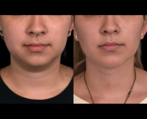 Double chin removal in Dubai