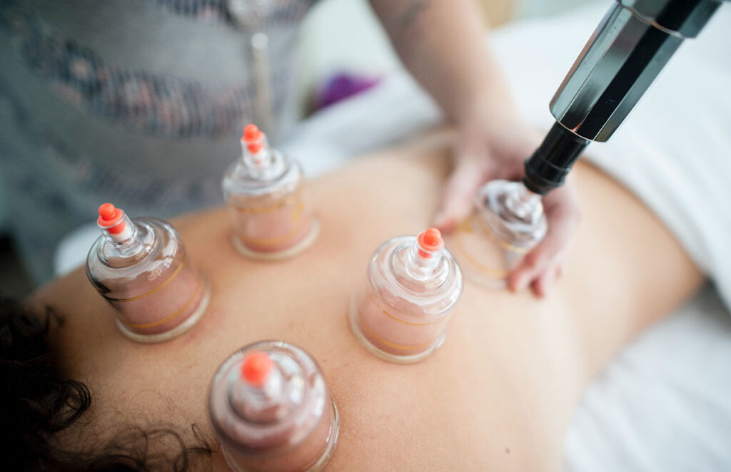 Cupping therapy treatment on back with suction cups improving blood circulation and relieving muscle tension at Physio Healing Hands.