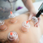 Cupping therapy treatment on back with suction cups improving blood circulation and relieving muscle tension at Physio Healing Hands.
