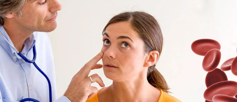 Iron-deficiency-anemia