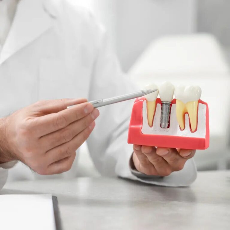 Dental Implants Explained: Procedure, Types, Benefits, and What You Should Know