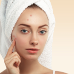 Acne Treatment In Manchester