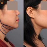 double chin liposuction