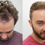 Hair Transplant