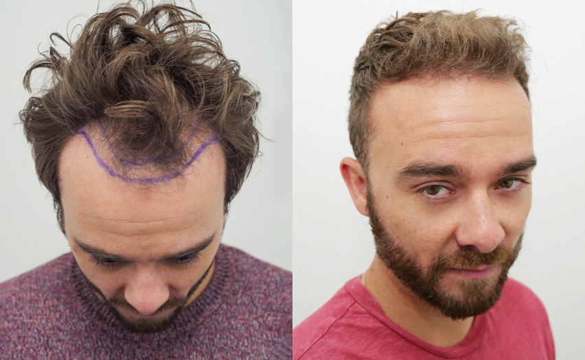 Hair Transplant