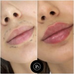 Juvederm in Dubai