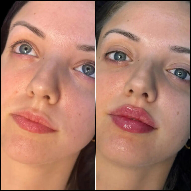 Fillers in Dubai
