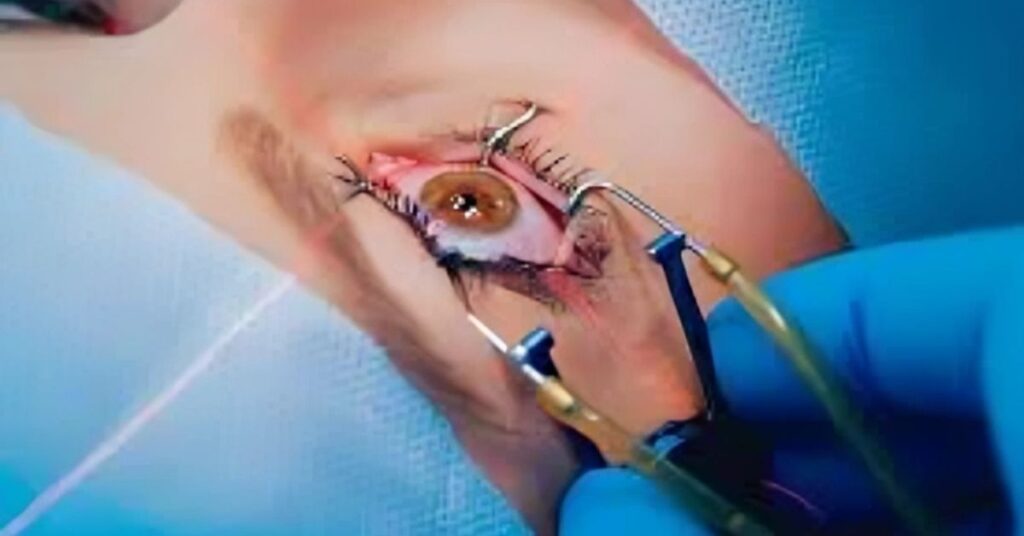 LASIK Surgery in Delhi at Shreya Eye Centre for safe and advanced laser vision correction to improve eyesight and reduce dependency on glasses.