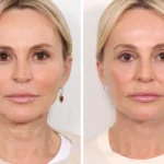 Thread lift by Best Doctors in Dubai for Smooth Skin Texture