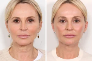 Thread lift by Best Doctors in Dubai for Smooth Skin Texture