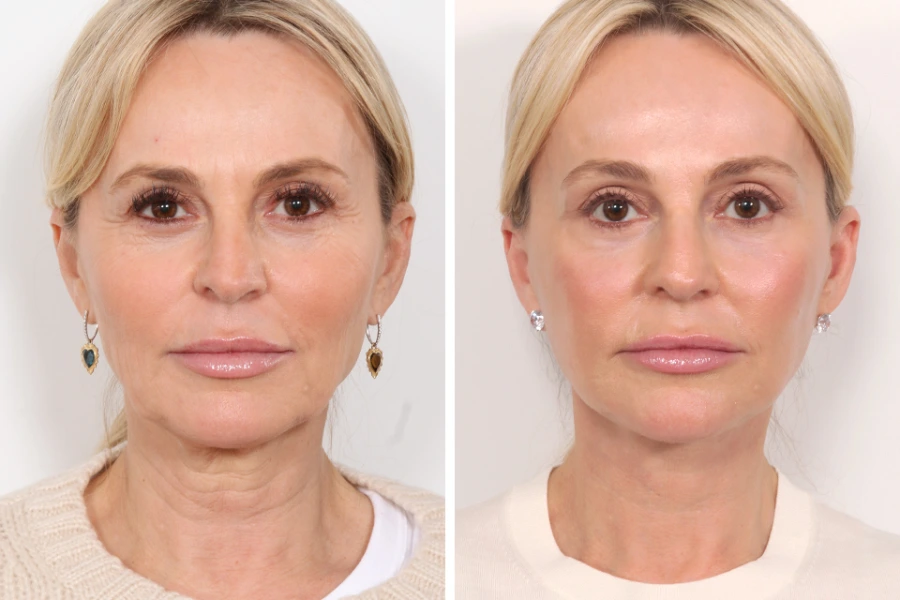 Thread lift by Best Doctors in Dubai for Smooth Skin Texture