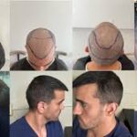 Best Hair Transplant Turkey: Complete Guide to FUE, DHI
