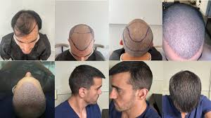 Best Hair Transplant Turkey: Complete Guide to FUE, DHI