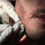 Beard Growth Treatment