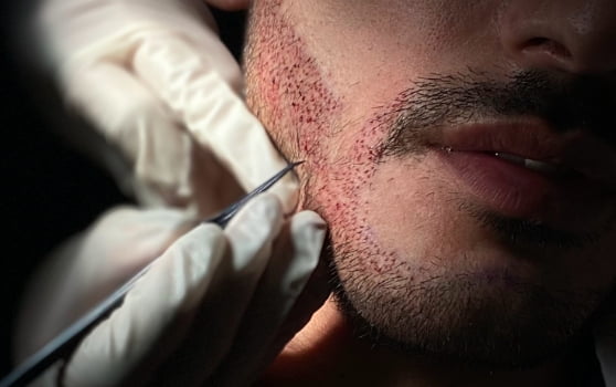 Beard Growth Treatment