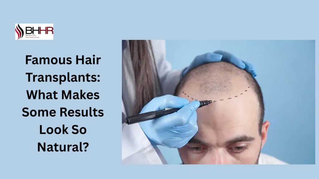 famous hair transplants