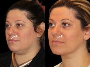 sculptra in dubai