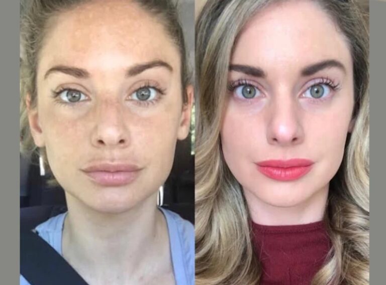 RF Microneedling in Dubai