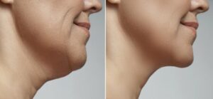 double chin liposuction